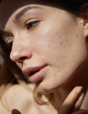 try this: 5 effective ways to treat persistent acne